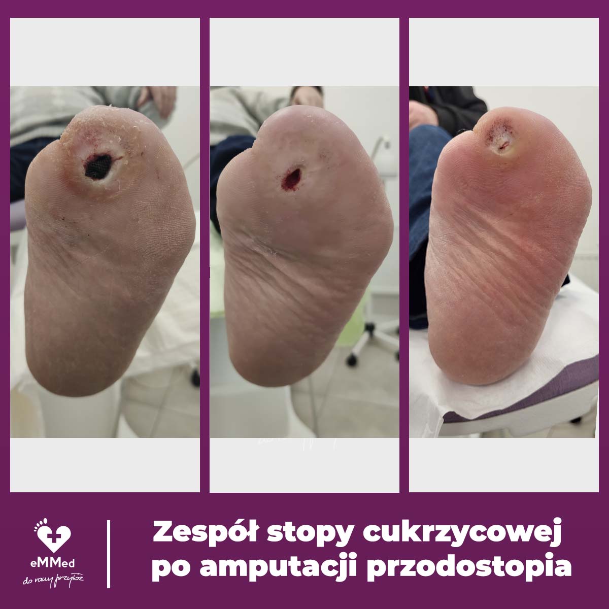Zespół stopy cukrzycowej po amputacji przedstopia